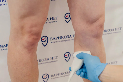 Венозный рефлюкс вен нижних конечностей